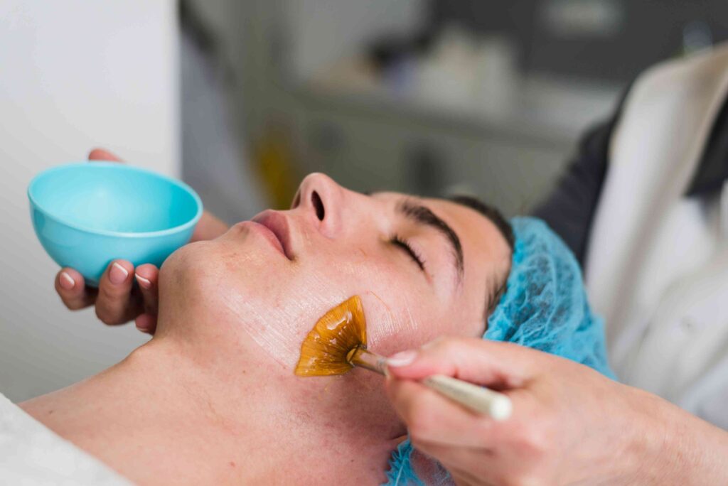 chemical peels in Mississauga