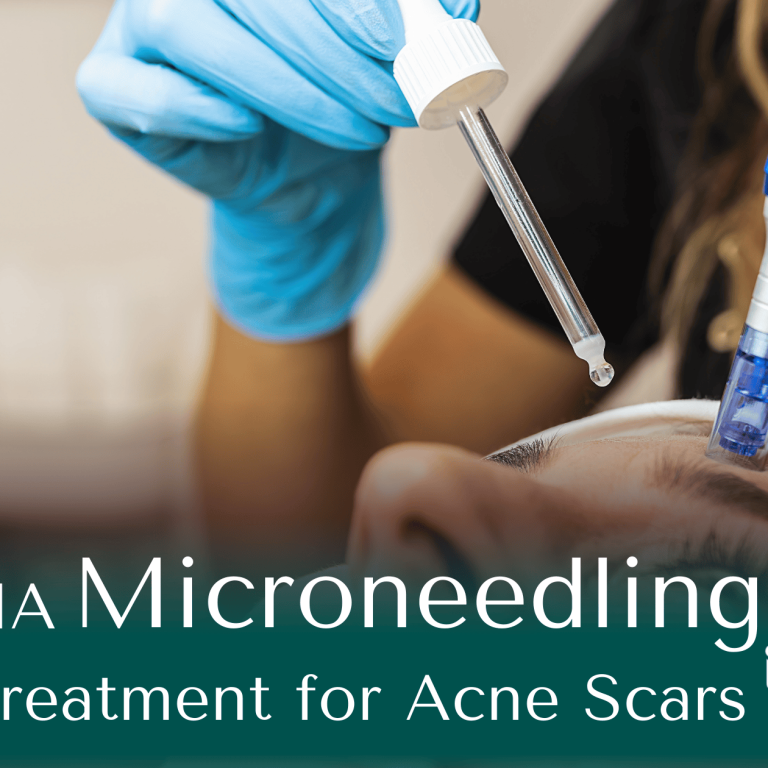 HA Microneedling Treatment for Acne Scars